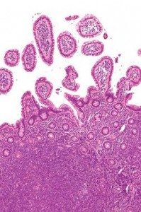 Micrografía que muestra un linfoma de células de manto (zona inferior de la imagen) en una biopsia de íleon terminal. / Wikipedia