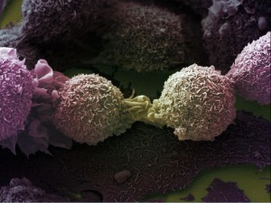 Células cancerígenas de pulmón. / Wellcomes Images