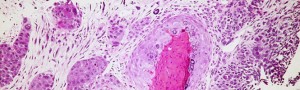 Células cáncer de mama. / Pulmonary Pathology (WIKIMEDIA COMMONS)
