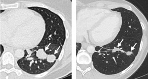 En la imagen puede verse el pulmón de la paciente antes y seis meses después de la ACT. / Jim Yang